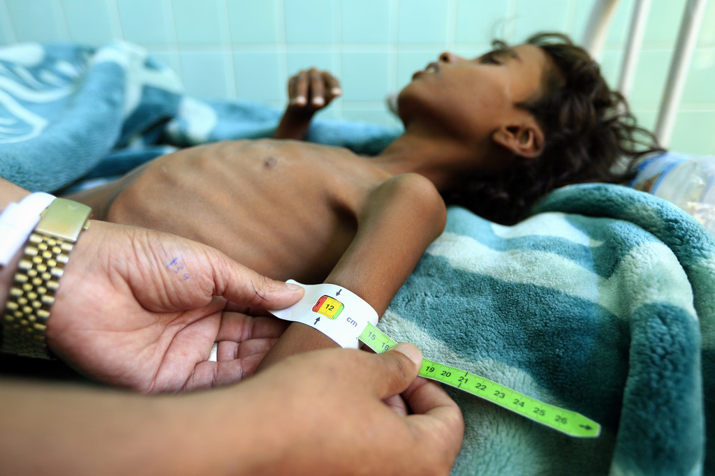 الصحة العالمية: 5 ملايين شخص معرضون لخطر المجاعة في اليمن