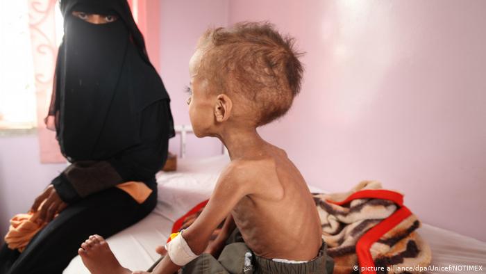 الأغذية العالمي: النزاع في اليمن ودول عربية أخرى يشعل فتيل الجوع