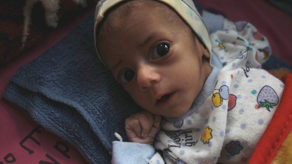 السعودية تقدم خمسة ملايين دولار لمكافحة سوء التغذية باليمن