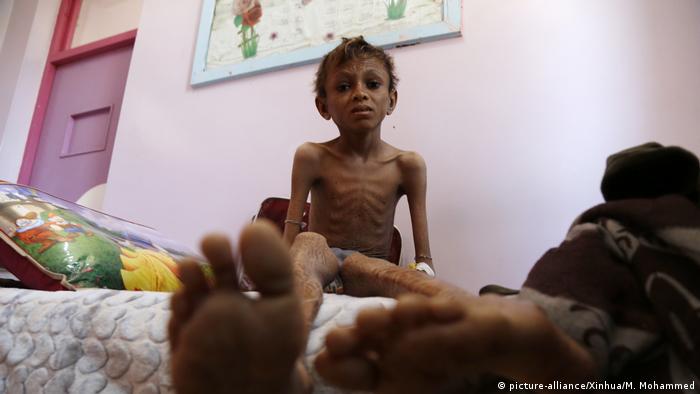 يونيسف: ملايين الأطفال يواجهون “مخاطر متزايدة” جراء سوء التغذية في اليمن